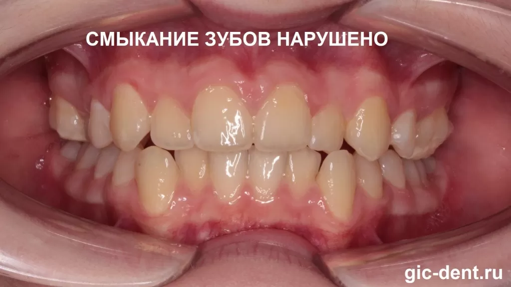 Фото нарушения смыкания зубов. Верхние резцы не перекрывают нижние. Исправление прикуса у ребенка брекетами h4